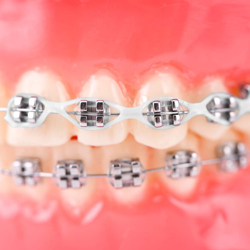 When does your orthodontist put power chains on braces?