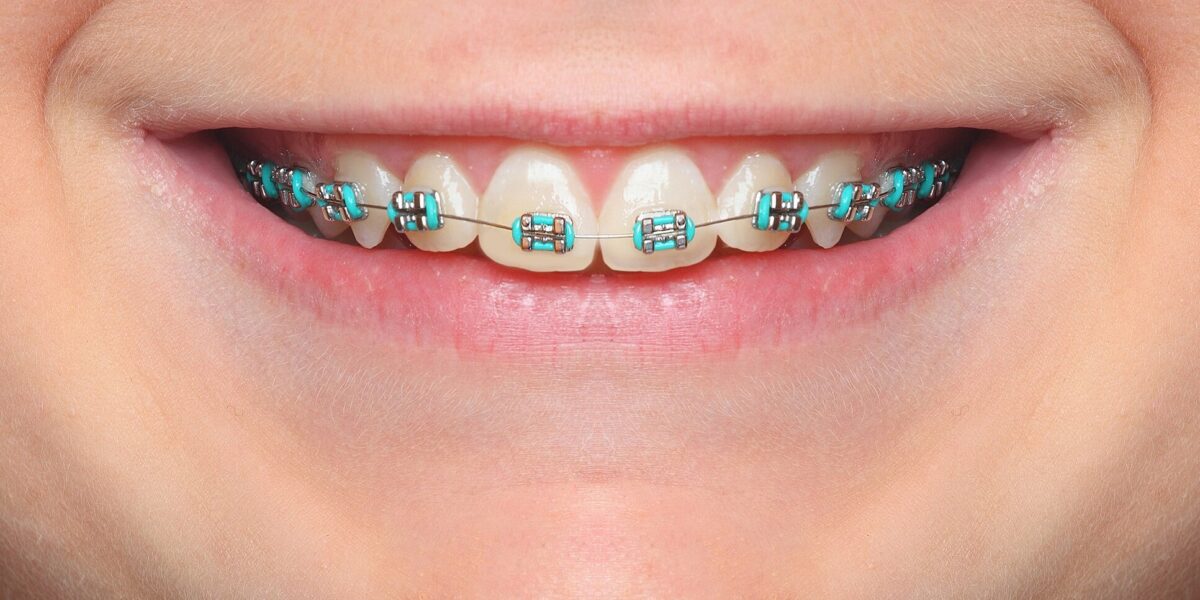 What are the most popular colors for braces?