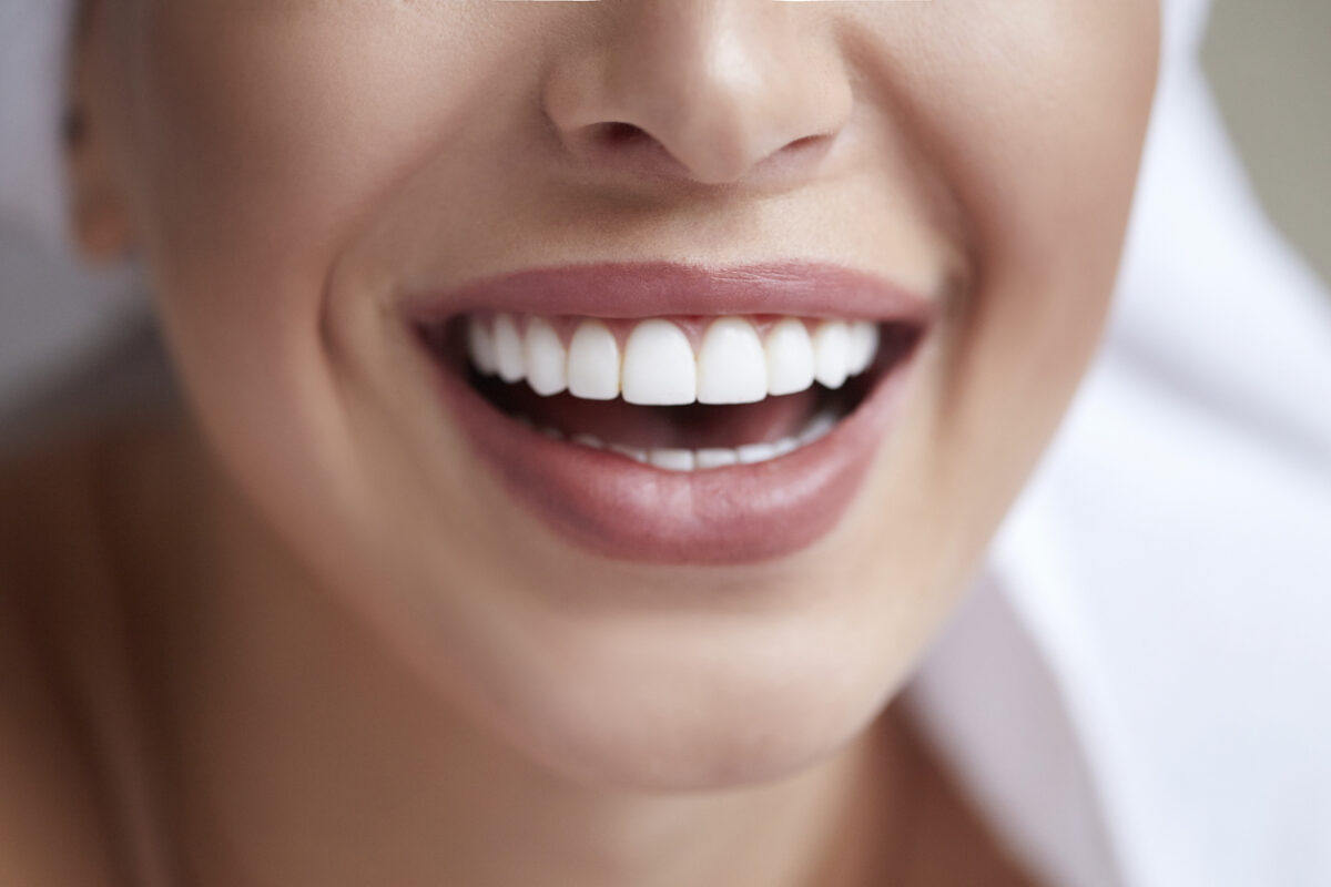 What is the Average Cost of Composite Veneers?