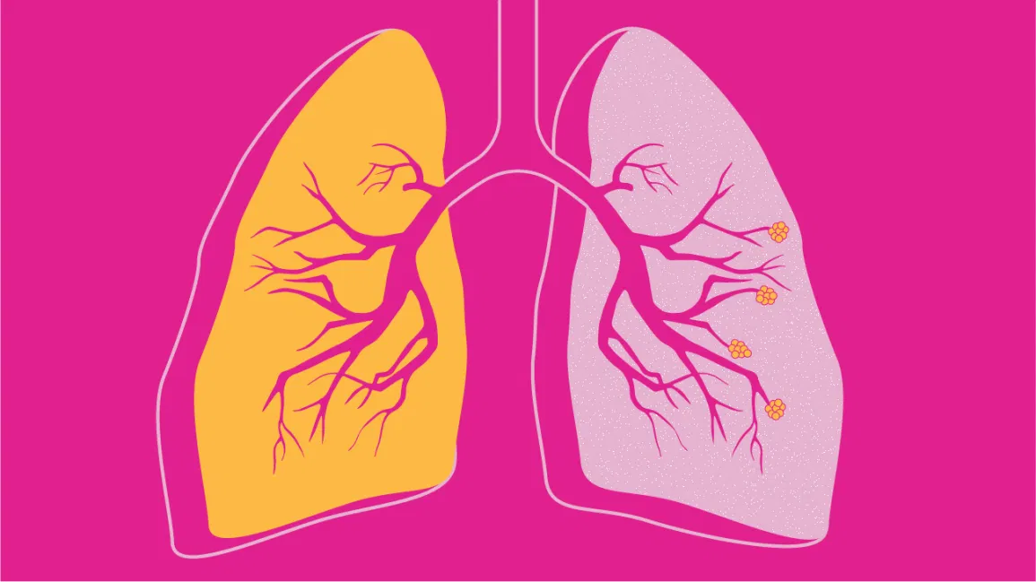 Does Chronic Bronchitis Increase Mortality Risk in Ever-Smokers?