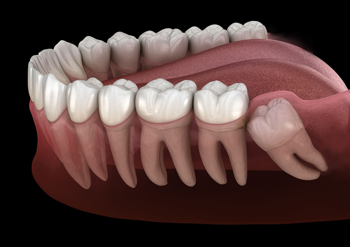 How To Sleep After Wisdom Teeth Removal Treatment