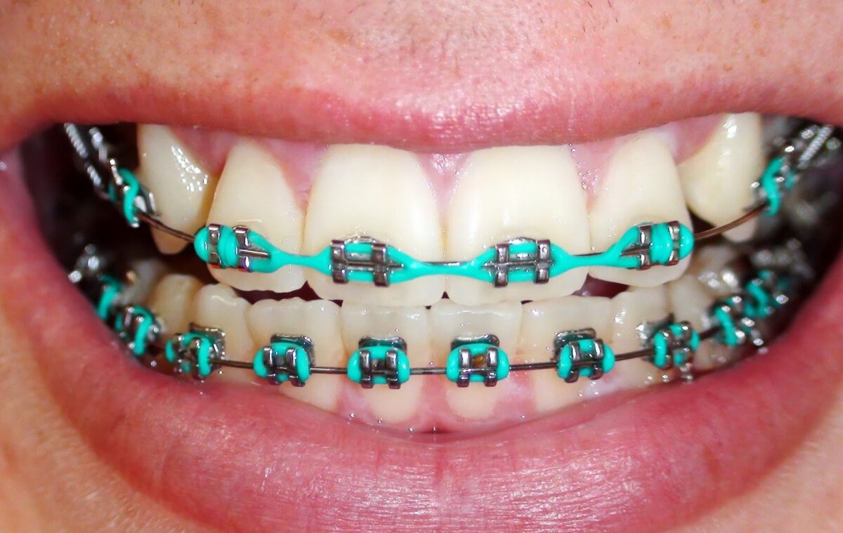 Can a normal dentist do braces? The answer may surprise you!