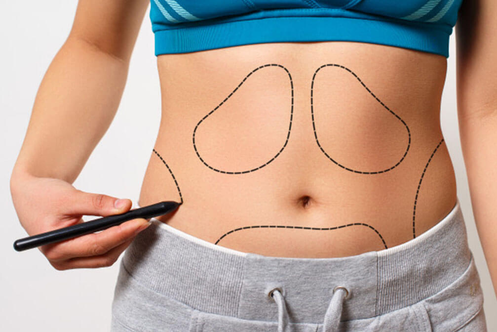 Best results of tummy tuck by professional doctors.