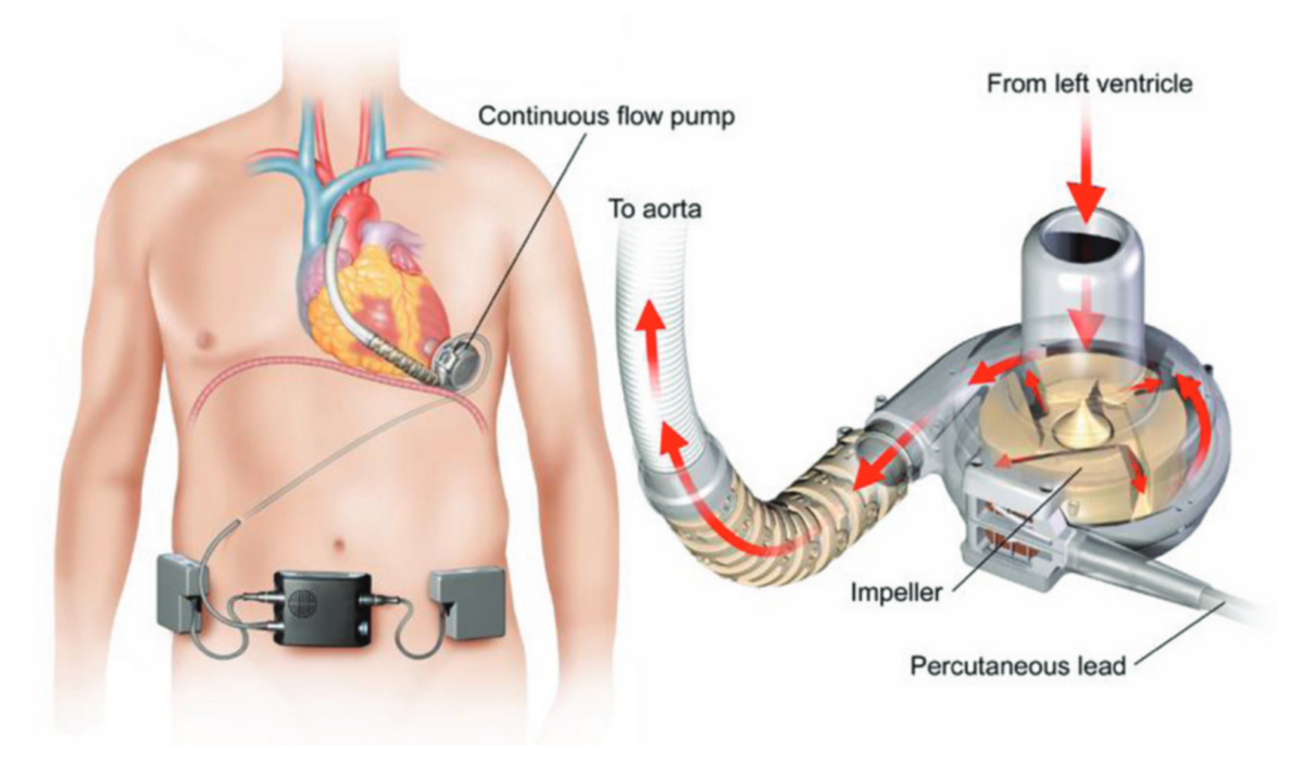 Ventricular Assist Devices Market Trends, Growth, and Report 2022-2027