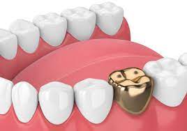 dental gold crowns