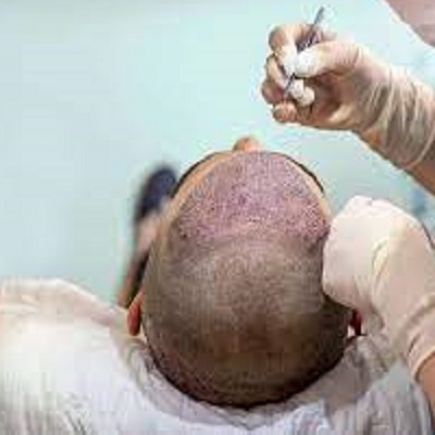 Can we exercise after hair transplant in Islamabad