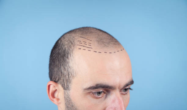 “Decoding Hair Transplant Costs: A Guide to Prices in Dubai”