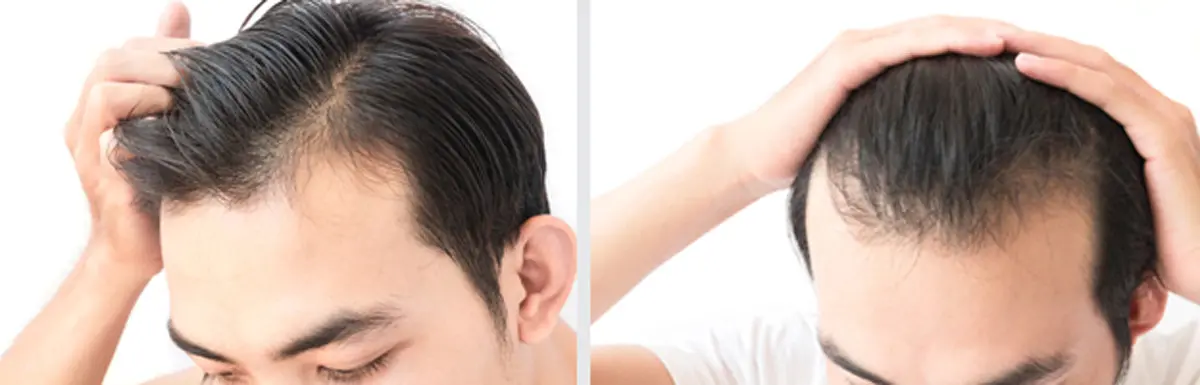 What are the Essential tips to sustain your beauty after hair transplant?