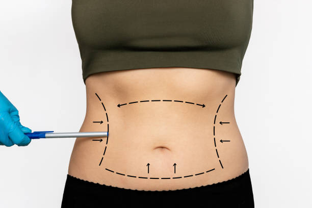 The Rise of Liposuction Trends in Dubai: What You Need to Know