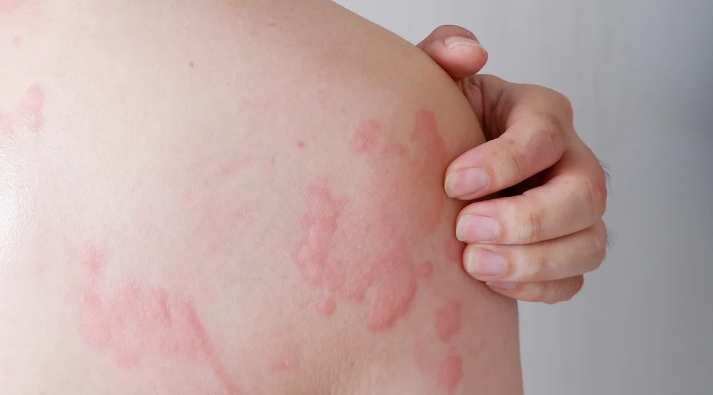 Hives Treatment in Aurora: Understanding and Alleviating Skin Woes