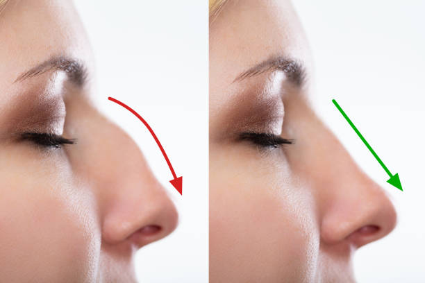 Rhinoplasty in Dubai