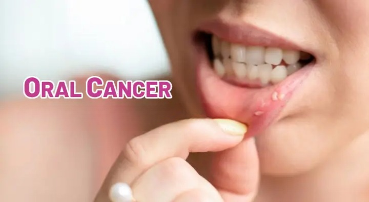 Development of Oral Cancer: Risk Factors and Prevention Strategies