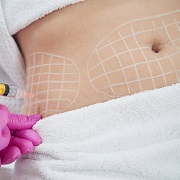 Pros & Cons: The Ultimate Guide to Fat Melting Injections for a Sculpted You