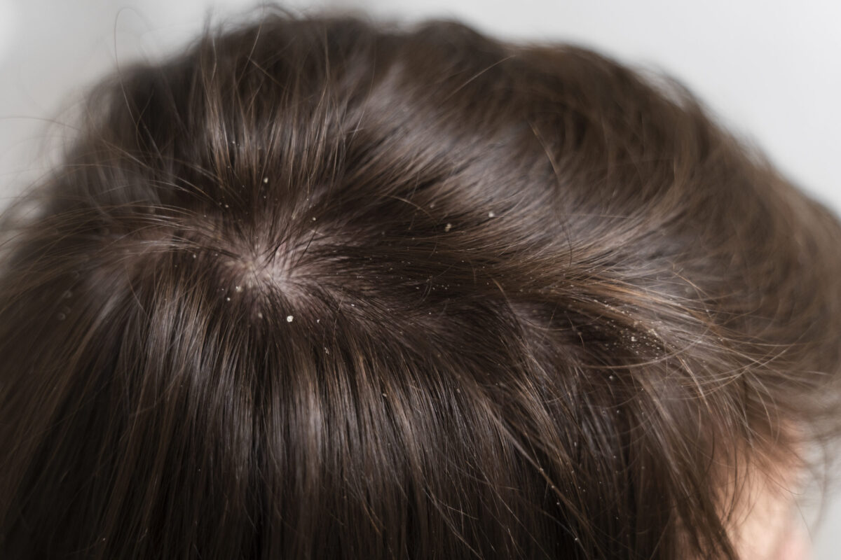 Dandruff Treatment in Borivali – Make your Hair Dandruff Free