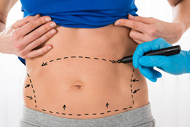 Exploring Tummy Tuck in Riyadh: Your Ultimate Guide to Cosmetic Surgery in the Capital