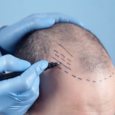 Unlocking Confidence: A Guide to Hair Transplant Surgery