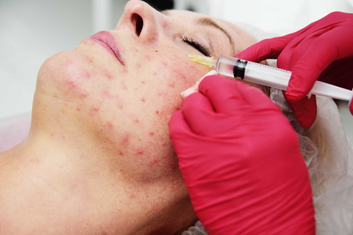 Dubai’s Leading Pimple Treatment Options