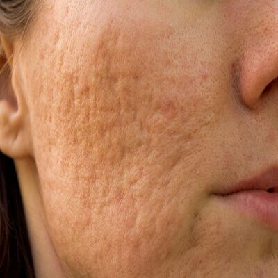 Your Pathway to Clearer Skin: Acne Scar Treatments in Dubai