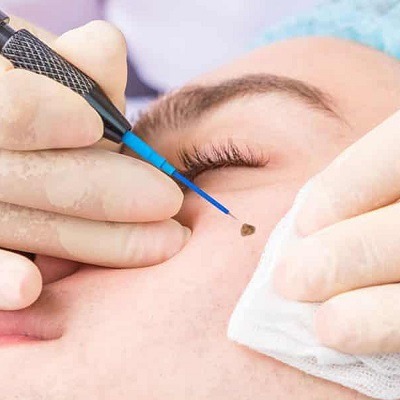 Wart Removal in Dubai: Clinics Offering Safe and Effective Treatments