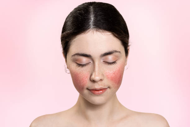 How Technology Is Changing Rosacea Treatment