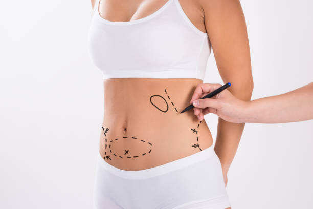 Redefining Silhouettes: Your Guide to Abdominoplasty in Riyadh