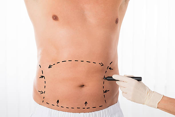 Achieve Your Ideal Shape: Abdominoplasty in Riyadh