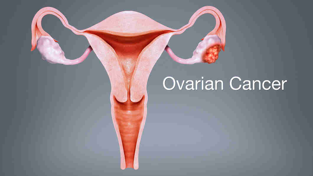 Preventing ovarian cancer