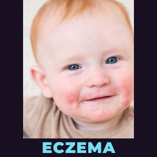 eczema in children