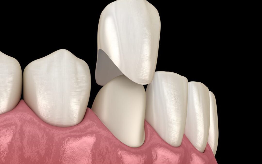Understanding Porcelain Crowns: A Comprehensive Guide for Patients in the UK