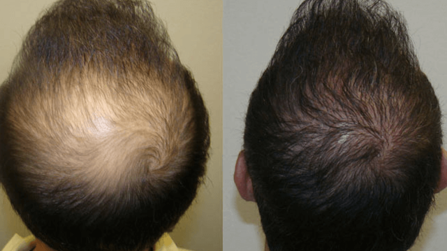 Synthetic Hair Transplant: A Complete Guide For Your Hair Transplant Journey