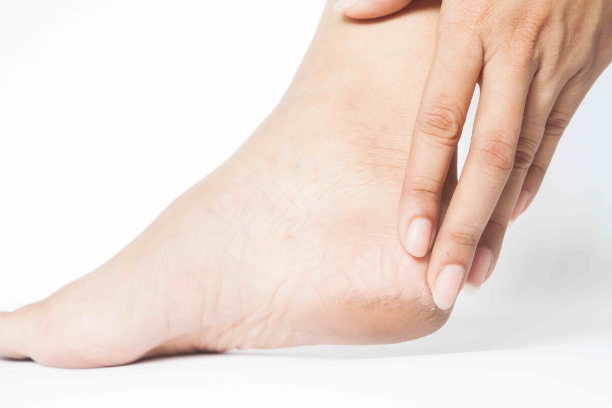 How to Apply Foot Cream Properly and Effectively?