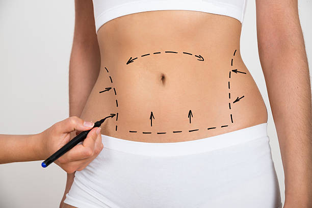 Top Clinics for Abdominal Liposuction in Riyadh