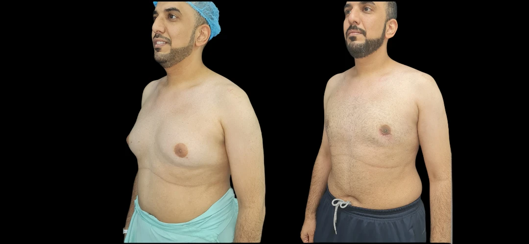 Gynecomastia Surgery for Bodybuilders in Dubai: Special Considerations