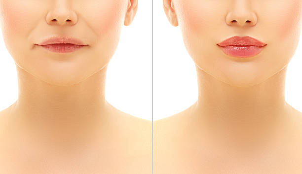 Riyadh Revitalized: Unveiling Lip Enhancement Secrets