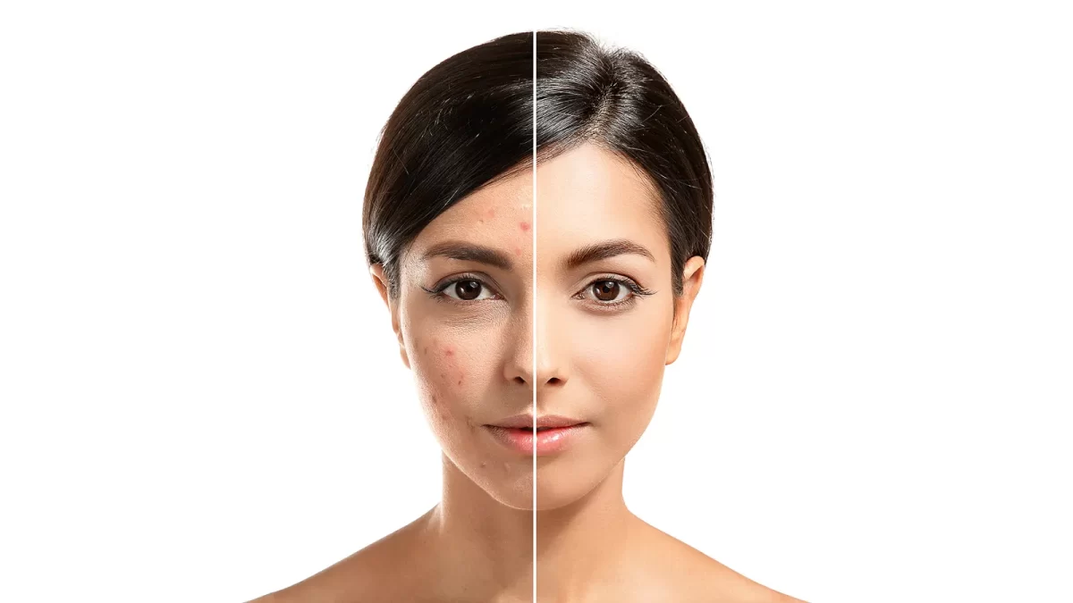 Unmasking Beautiful Skin: Acne Scar Treatments in Islamabad