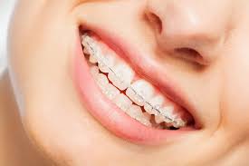Diamond Braces: Where Elegance Meets Orthodontics