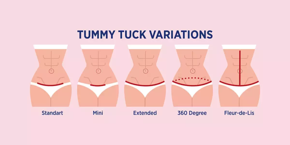 Can I get a 360 Lipo without Tummy Tuck?