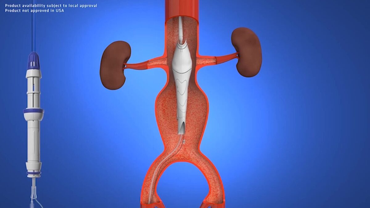 North America Aortic Stent Graft Market