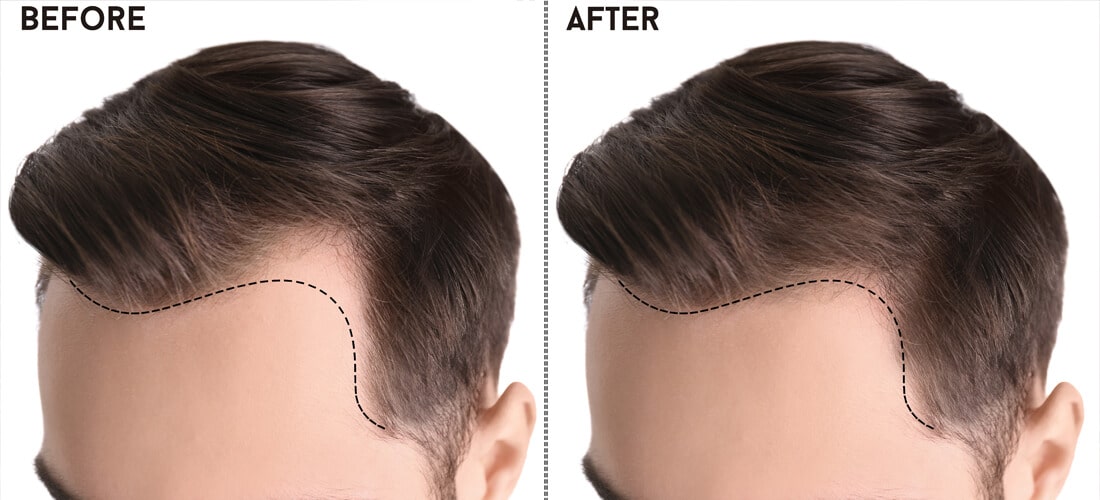 Unlocking Confidence: Exploring Hair Transplantation in Islamabad