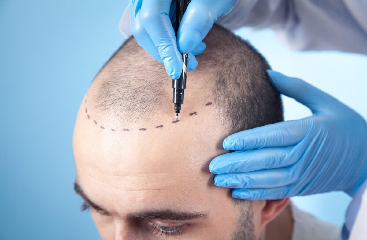 Get a Natural Hairline with Hair Transplant in Islamabad