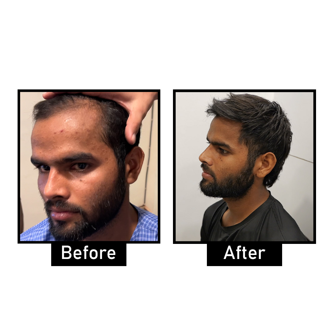 Effective Hair Loss Treatments in Delhi: Options for Thinning Hair and Balding