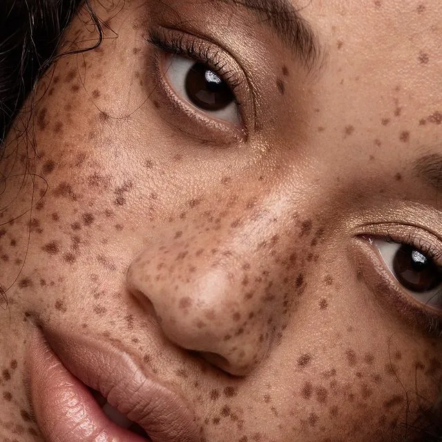 Dermal Pigmentation in Islamabad: Tips for Effective Prevention