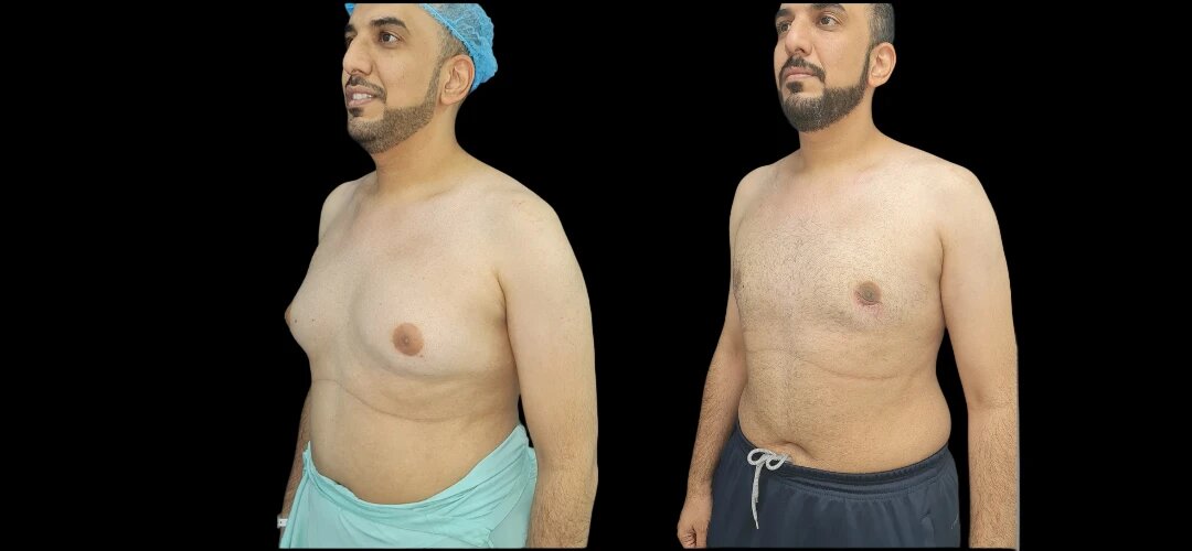 Benefits of Choosing the Best Gynecomastia Surgeons in Dubai for Male Breast Reduction