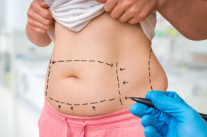 Liposuction Surgery in Duabi