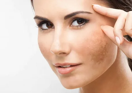 How to Find the Best Melasma Treatment in Islamabad: Expert Solutions and Insights