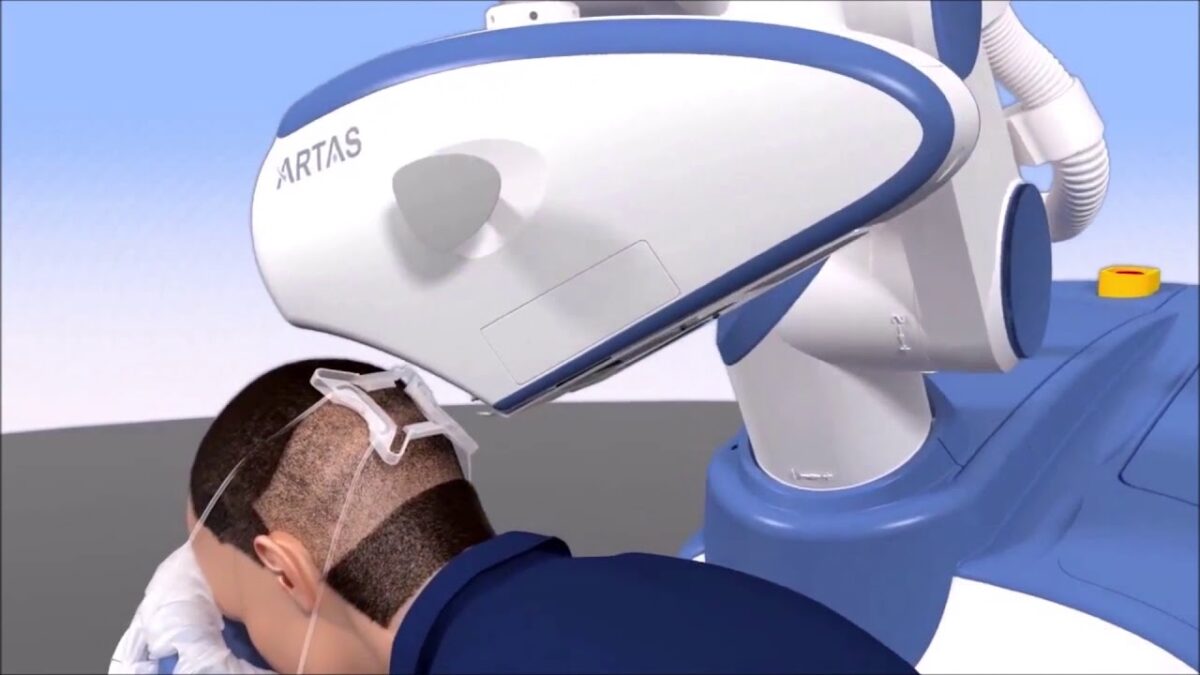 The Recovery Process After Robotic Hair Transplant in Islamabad: What to Expect