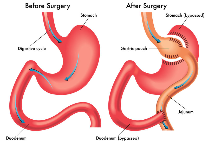 Affordable Gastric Bypass Surgery for Weight Loss in Pakistan
