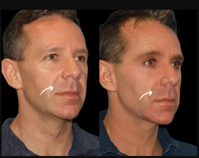 Cost vs. Value: Is Sculptra Fillers Treatments in Dubai Worth It?