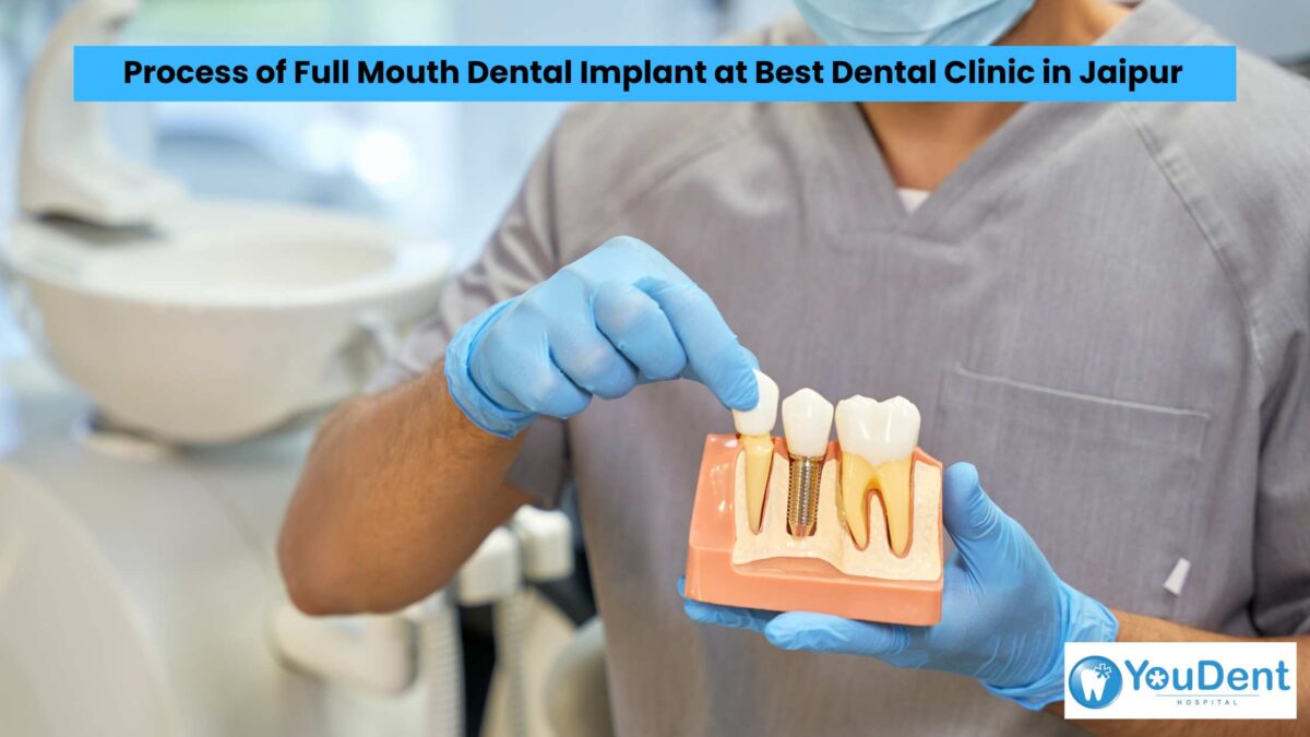 Process of Full Mouth Dental Implant at Best Dental Clinic in Jaipur