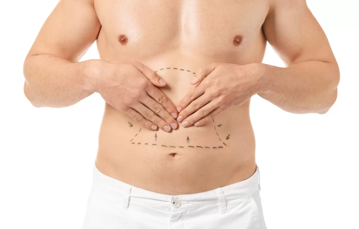 Best Tummy Tuck Surgeon in Dubai